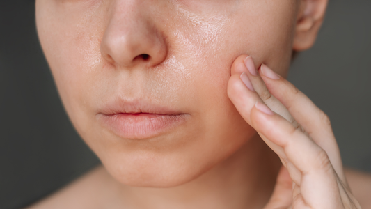 Why Is My Skin Oily but Flaky? Understanding the Oily–Dry Skin Paradox