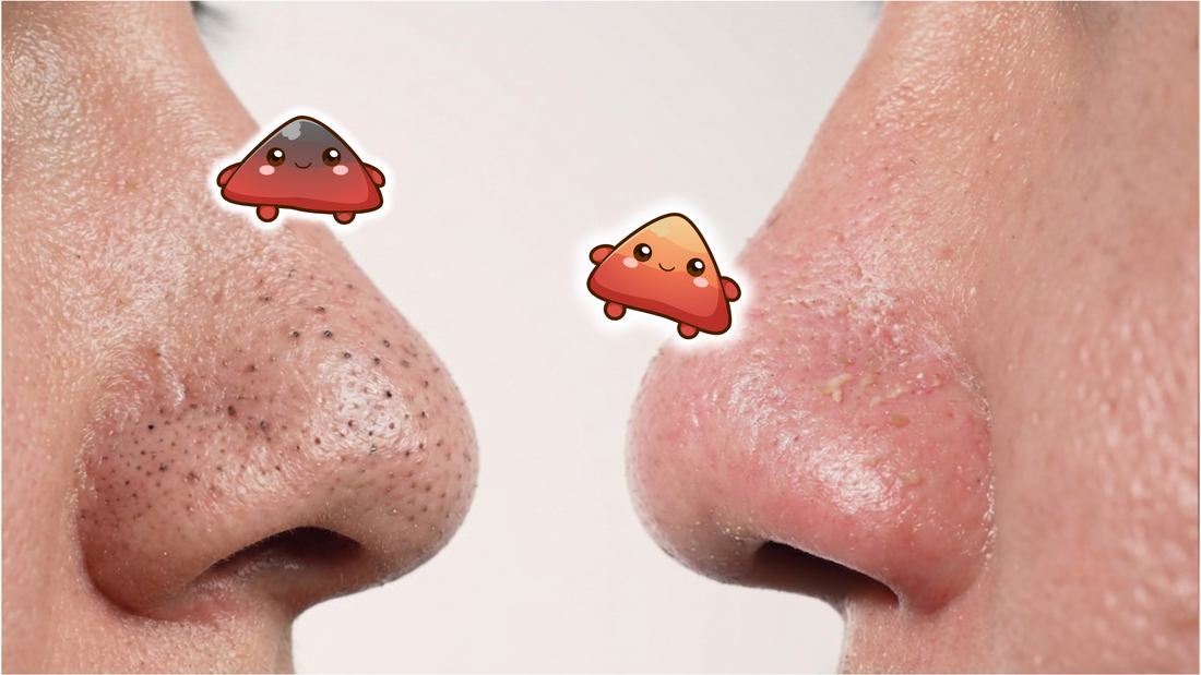 Sebaceous Filaments vs. Blackheads: What's the Difference?