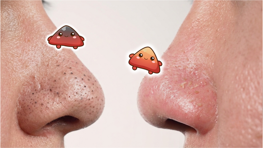 Sebaceous Filaments vs. Blackheads: What's the Difference?