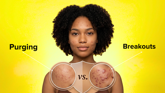 Skin Purging vs. Breaking Out: How to Tell the Difference