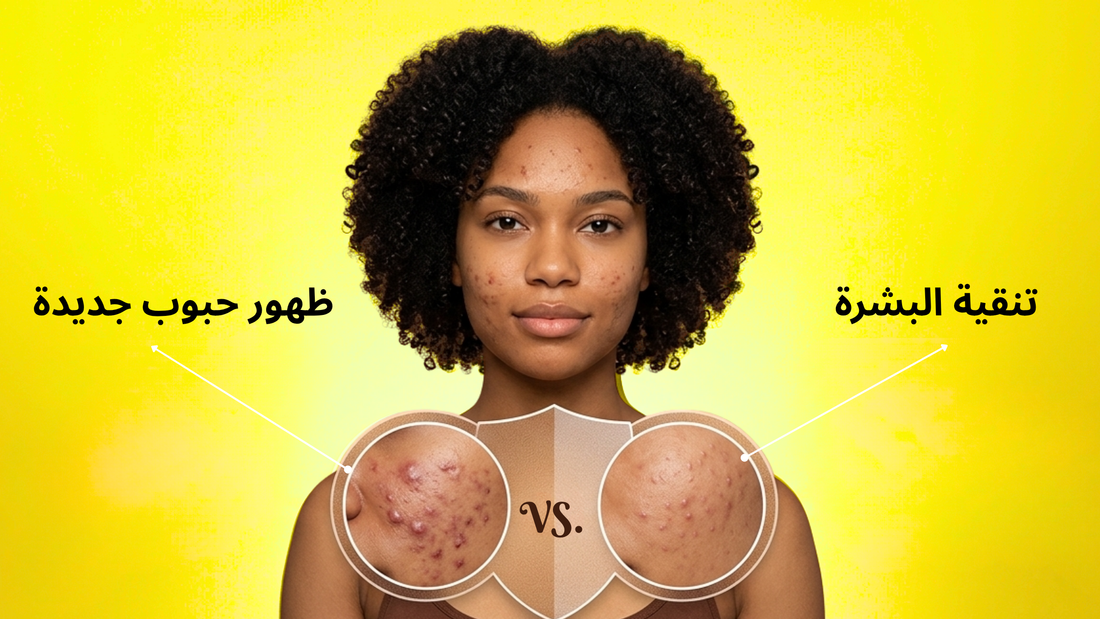 تنقية البشرة أم ظهور حبوب جديدة؟ كيف تميّز بينهما؟
