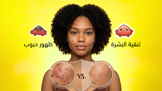 تنقية البشرة أم ظهور حبوب جديدة؟ كيف تميّز بينهما؟