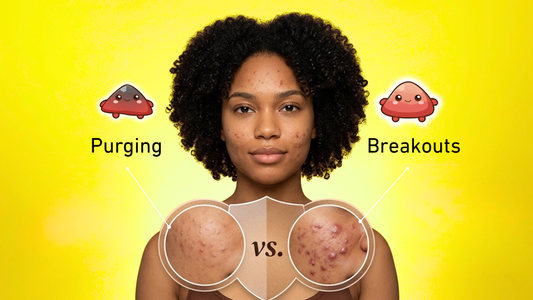 Skin Purging vs. Breaking Out: How to Tell the Difference