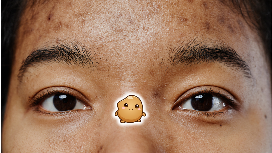 Acne Scars Explained: Why Some Pimples Leave Permanent Scars