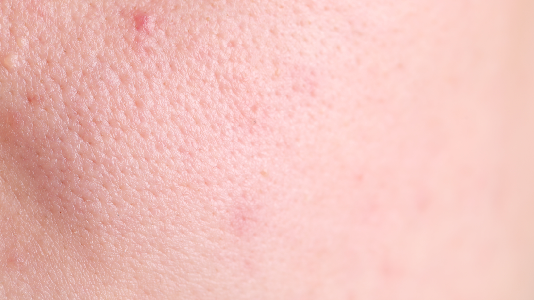 What Are Enlarged Pores? Can You Actually Shrink Them?