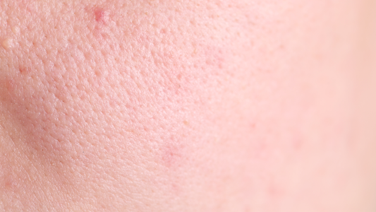 What Are Enlarged Pores? Can You Actually Shrink Them?