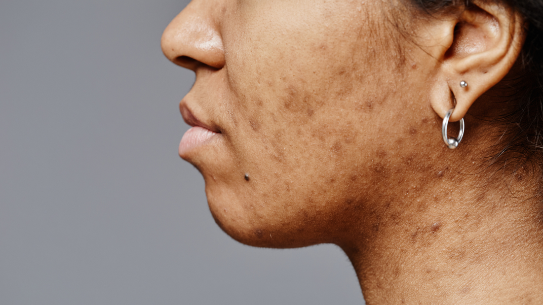 Types of Skin Pigmentation: A Complete Guide to Understanding Skin Discoloration