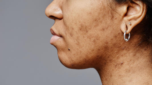 Types of Skin Pigmentation: A Complete Guide to Understanding Skin Discoloration