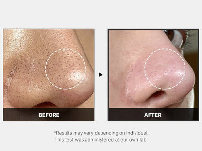 Clinical before and after photo showing visible reduction in blackheads and pore size on the nose.