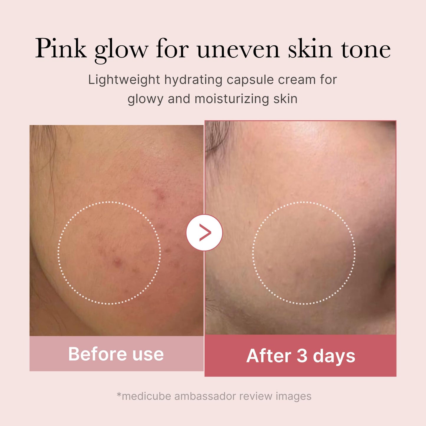 Skin results after 3 days of using Medicube PDRN cream showing reduced redness and glow.