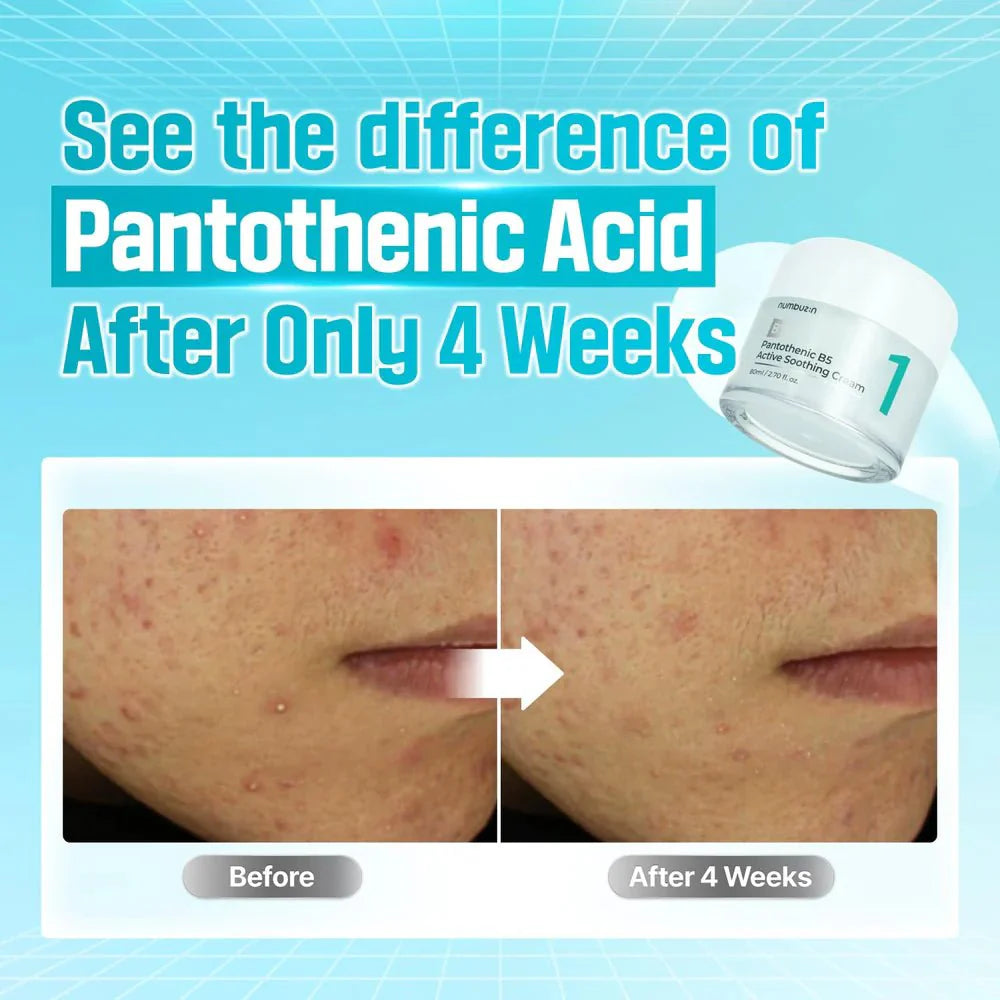 Before and after comparison showing reduced acne after 4 weeks of using Numbuzin No.1 Cream.