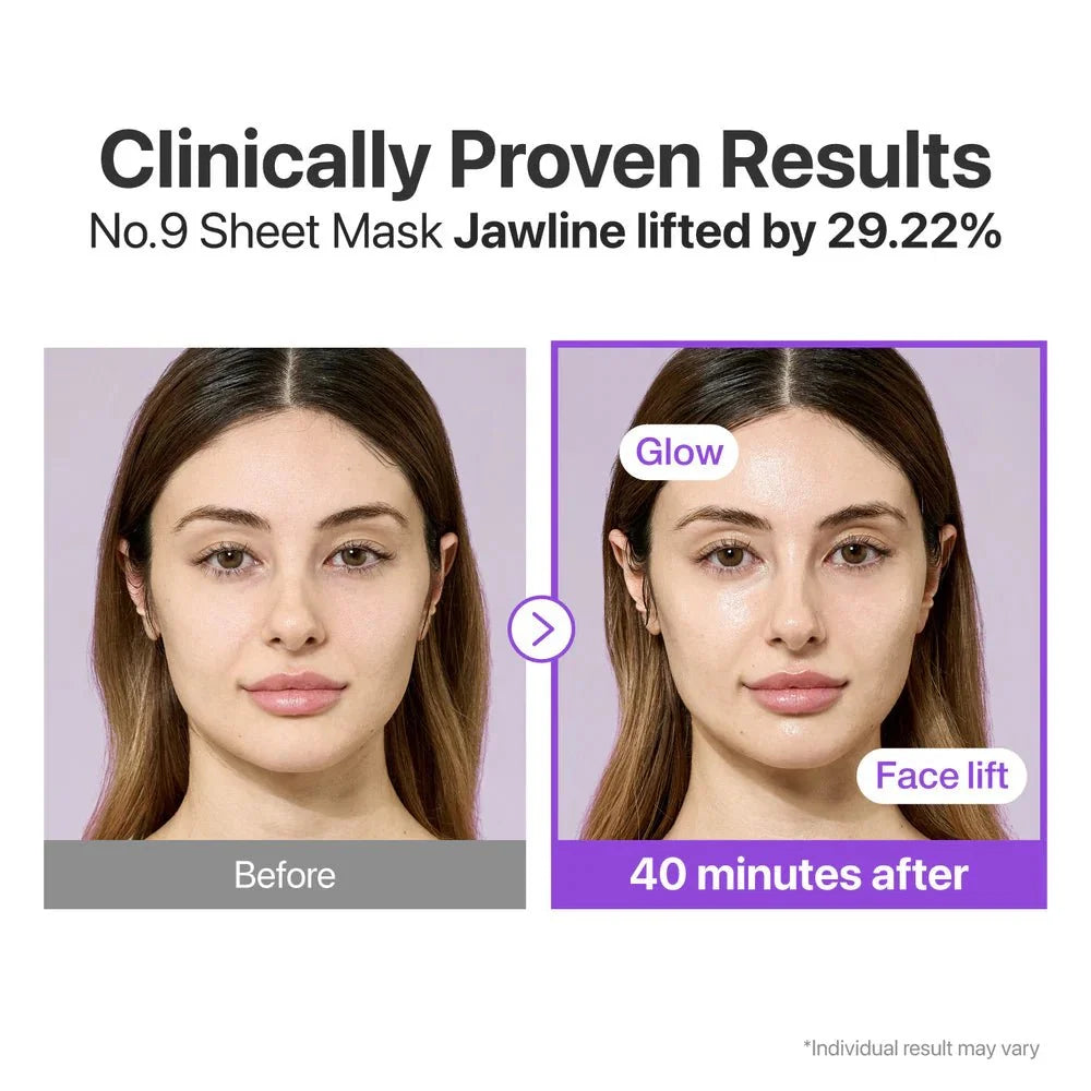 Before and after profile view showing the lifting effect on the jawline after 40 minutes.