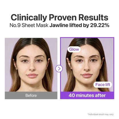 Before and after profile view showing the lifting effect on the jawline after 40 minutes.